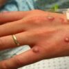 Monkeypox