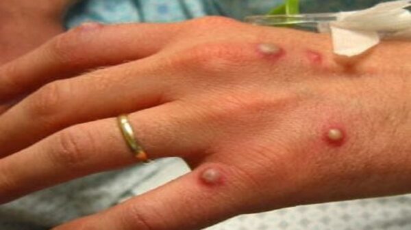 Monkeypox