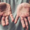 မျောက်ကျောက် (Monkeypox)ရောဂါ