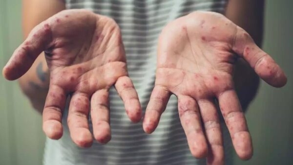 မျောက်ကျောက် (Monkeypox)ရောဂါ
