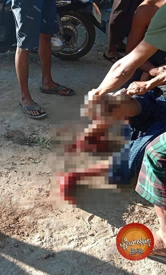 စစ်ကောင်စီတပ်ထောင်ထားခဲ့သောနင်းမိုင်းကြောင့် မိုင်းထိပြီးခြေထောက်ခိုက်သွားသည့်လူငယ်အား တွေ့ရစဥ်၊ဓာတ်ပုံ-နွေဦးတော်လှန်ရေး-မြိုင်