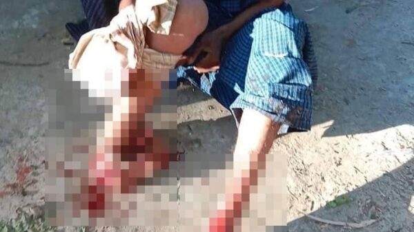 စစ်ကောင်စီတပ်ထောင်ထားခဲ့သောနင်းမိုင်းကြောင့် မိုင်းထိပြီးခြေထောက်ခိုက်သွားသည့်လူငယ်အား တွေ့ရစဥ်၊ဓာတ်ပုံ-နွေဦးတော်လှန်ရေး-မြိုင်