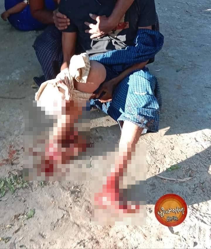 စစ်ကောင်စီတပ်ထောင်ထားခဲ့သောနင်းမိုင်းကြောင့် မိုင်းထိပြီးခြေထောက်ခိုက်သွားသည့်လူငယ်အား တွေ့ရစဥ်၊ဓာတ်ပုံ-နွေဦးတော်လှန်ရေး-မြိုင်