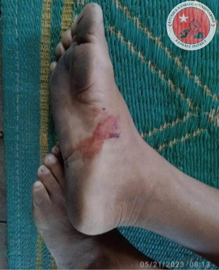 (ကန့်ဘလူခရိုင်အတွင်းမြွေဆိုးကိုက်ခံရမှုအခြေပြအင်ဖိုဂရပ်/ စစ်ဘေးရှောင်များကိုအန္တရာယ်ပြု၍သတ်ထားသောမြွေပွေးများ/မွေးကိုက်ခံထားရသောစစ်ဘေးရှောင်တစ်ဦး/ယူနီဆက်မြန်မာ၏မြွေဆိုးအန္တရာယ်အသိပညာပေးလက်ကမ်းစာစောင်။ ဓာတ်ပုံ-ကျွန်းလှ ကန့်ဘလူ တက်ကြွလှုပ်ရှားသူများအဖွဲ့-ကန့်ဘလူခရိုင်)
