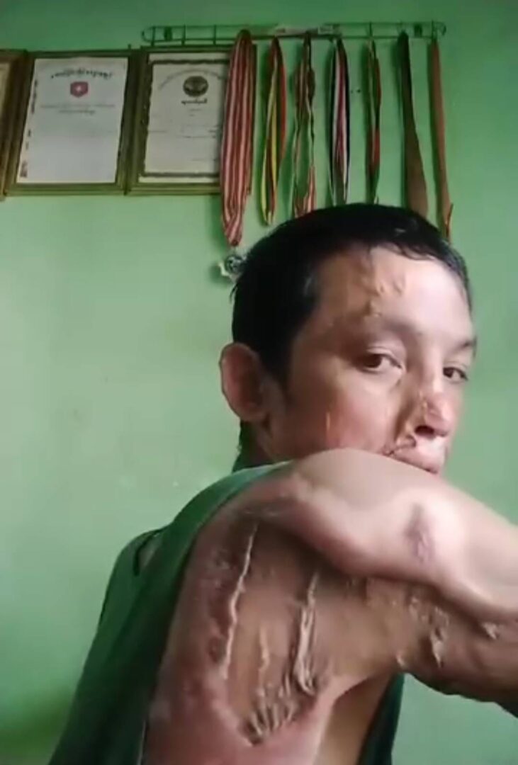 (ကရင်နီတိုက်ပွဲမှ အမာရွတ်များကိုပြသနေသောစစ်ကောင်စီတပ်သား တပ်ကြပ်ဇင်မင်းထက်အောင်။ ဓါတ်ပုံ-ဇင်မင်းထက်အောင်၏ရုပ်သံဖိုင်မှ)