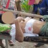 (အာဏာသိမ်းစစ်ကောင်စီတပ်က လက်နက်ကြီး ပစ်ခတ်မှုကြောင့် ထိခိုက်ဒဏ်ရာရသူတစ်ဦးအား တွေ့ရစဉ်။ ဓာတ်ပုံ - KNU)